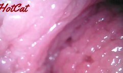 Endoscopic ♥vaginal observation